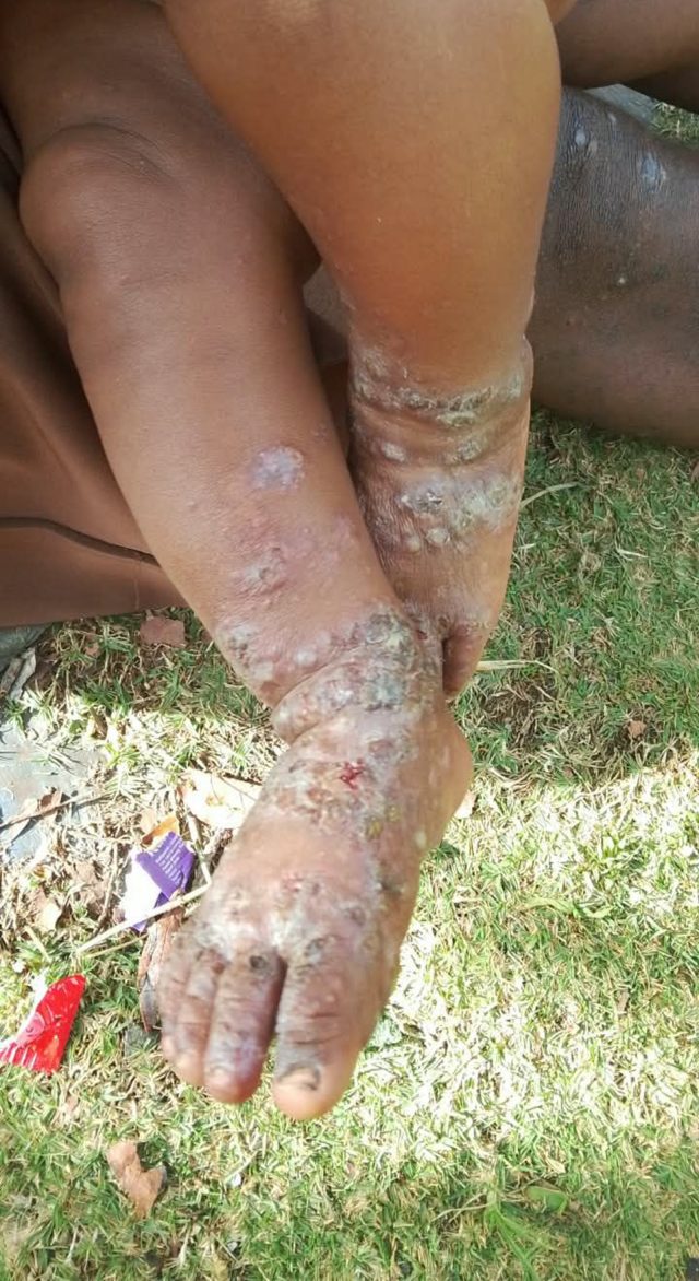 Penyakit Kulit yang diderita masayarakat di delapan kampung di Distrik Mewoluk, Kabupaten Puncak Jaya, Papua Tengah. (Foto: Humas PPPT)